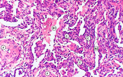 5 claves para diagnosticar Fibrosis Pulmonar Idiopática con Tomografía