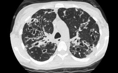 ¿Qué son las bronquiectasias?