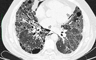 Fibroenfisema pulmonar: EPOC y fibrosis pulmonar